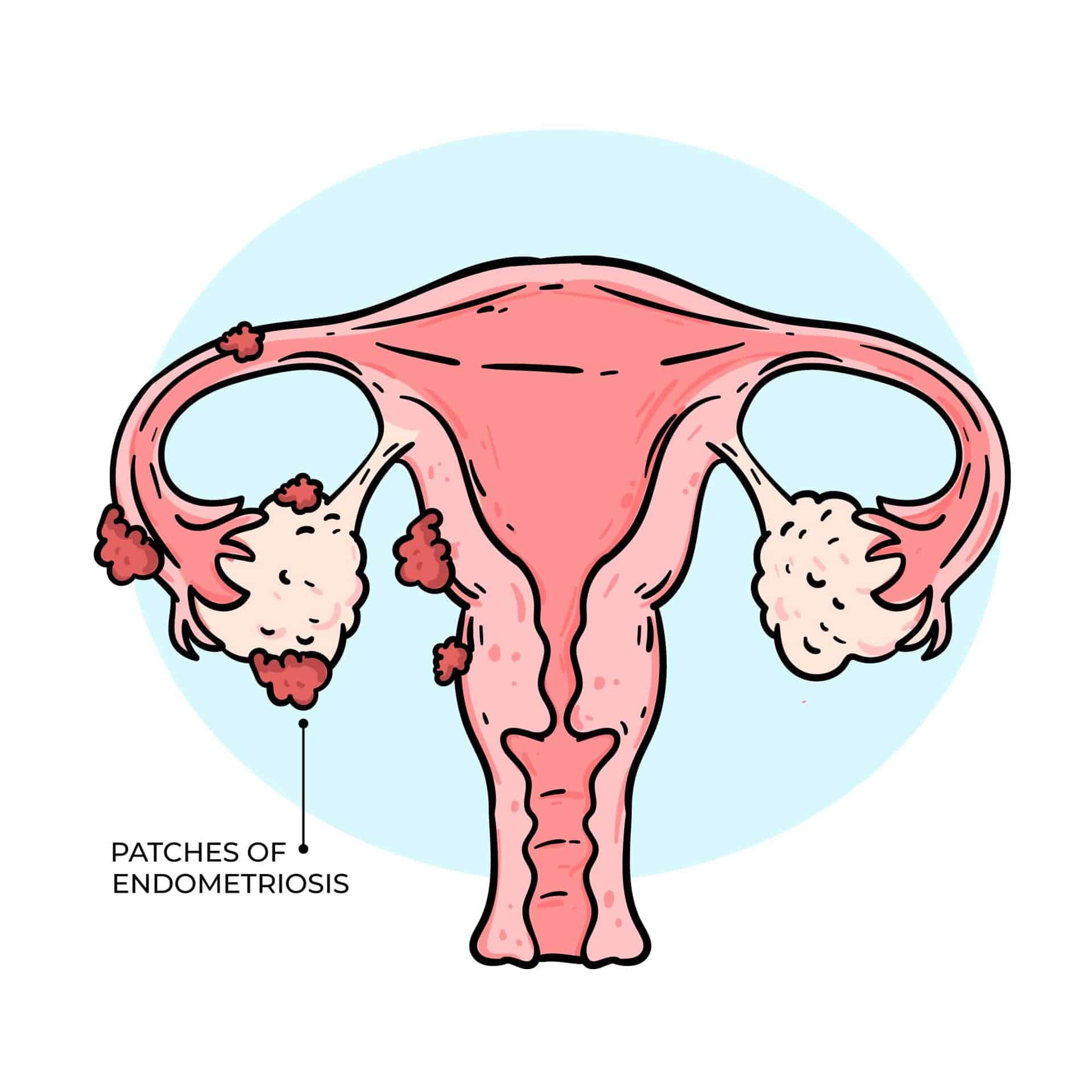 Endometriosis: Understanding Its Impact and Exploring Treatment Avenues
